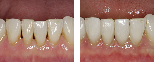 Wichtige Verbesserungen für die Ästhetik Ihres Lächelns durch kleine Korrekturen an Form und Farbe der Zähne.