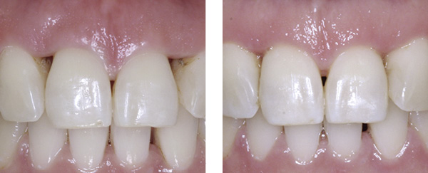 Gegenüberstellung: Vor und nach dem Zahnfleischmanagement
