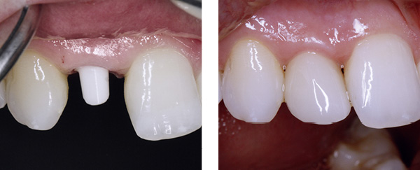 Das Implantat mit und ohne Zahnkrone.