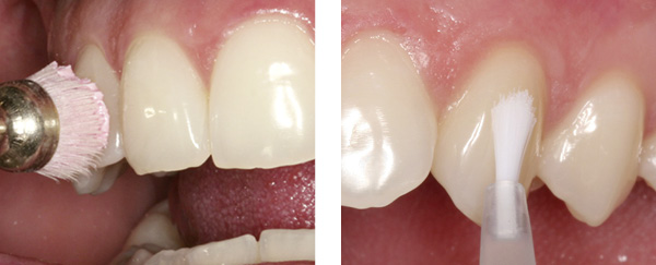 Vorbeugen ist besser als heilen: Individuelle Präventivmedizin für Ihre Zähne.