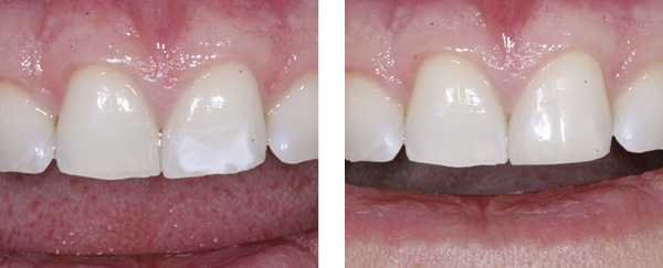 Hochwertiger, keramisch gefüllter Kunststoff für kleinere Zahnschäden am Beispiel eines Schneidezahns.
