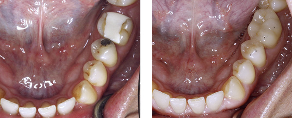 Keramik-Inlays für größere Zahnschäden am Beispiel von Backenzähnen im Unterkiefer.
