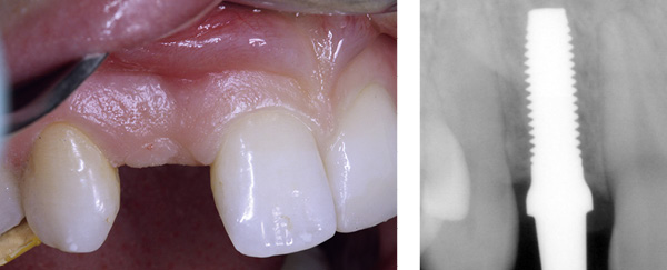 Fehlender Zahn und das dazugehörige Röntgenbild mit gesetztem Implantat.